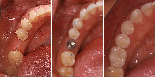 Les étapes du remplacement de dents: La mise en place de l'implant, du plilier, et de la couronne