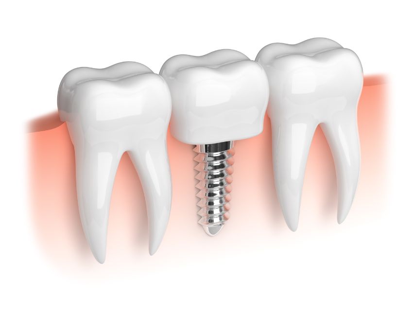 meilleure marque d'implant dentaire 