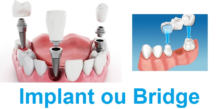 Photo d'un implant dentaire et d'un bridge dentaire