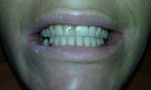 Des dents avant un traitement dentaire esthétique