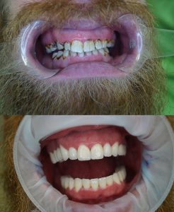 Dents avant et après le traitement des couronnes dentaires en zircon en Hongrie