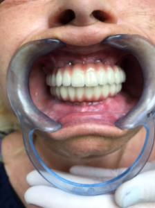 Dents en zircone, All-on-6