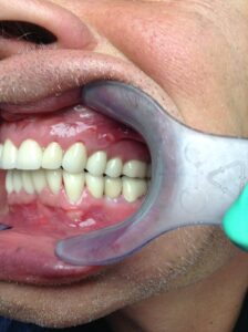 Des dents avec des couronnes en zircone apres le traitement á Budapest