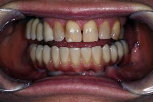 Des dents inférieure all-on 4 en zirconoium