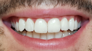 Des dents avec des facettes en zircone apres les traitements