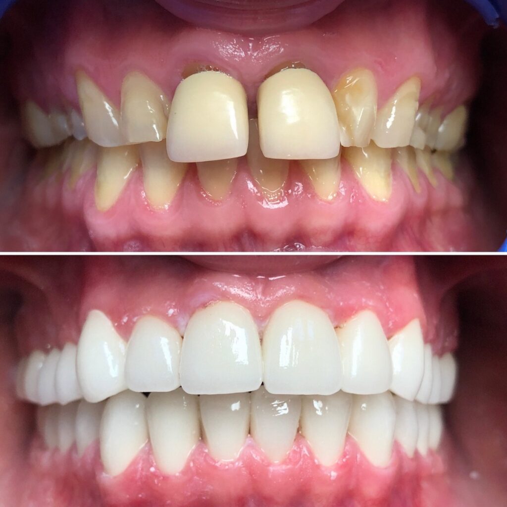 Dents avant et après le traitement des couronnes dentaires en zircon en Hongrie