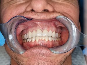 Des dents avec des facettes en e-max porcelain apres les traitements