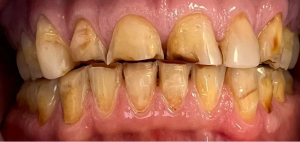 Des dents avant le traitement á Budapest
