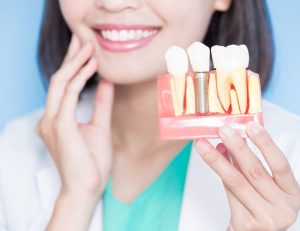 Implants dentaires Alpha-Bio